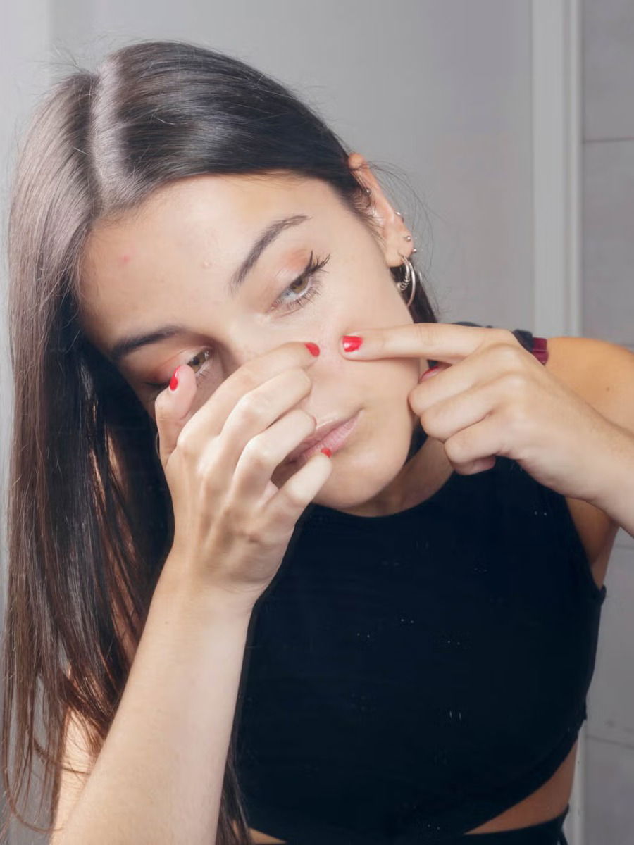 Home Remedies for Pimples - News | Home Remedies for Pimples | Latest Photos at Lokmattimes.com